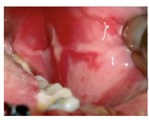 white lesions inside of a mouth